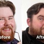 Michael Baggott Weight Loss, surgery before and after