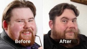 Michael Baggott Weight Loss, surgery before and after