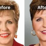 Joyce Meyer's Plastic Surgery Journey, Before & After