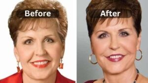 Joyce Meyer's Plastic Surgery Journey, Before & After