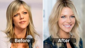 Kaitlin Olson Plastic Surgery, Before & After
