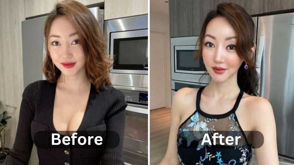 Yeonmi Park Surgery, Before & After