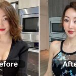Yeonmi Park Surgery, Before & After