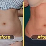 Lipo 360 Before and After Transformations new