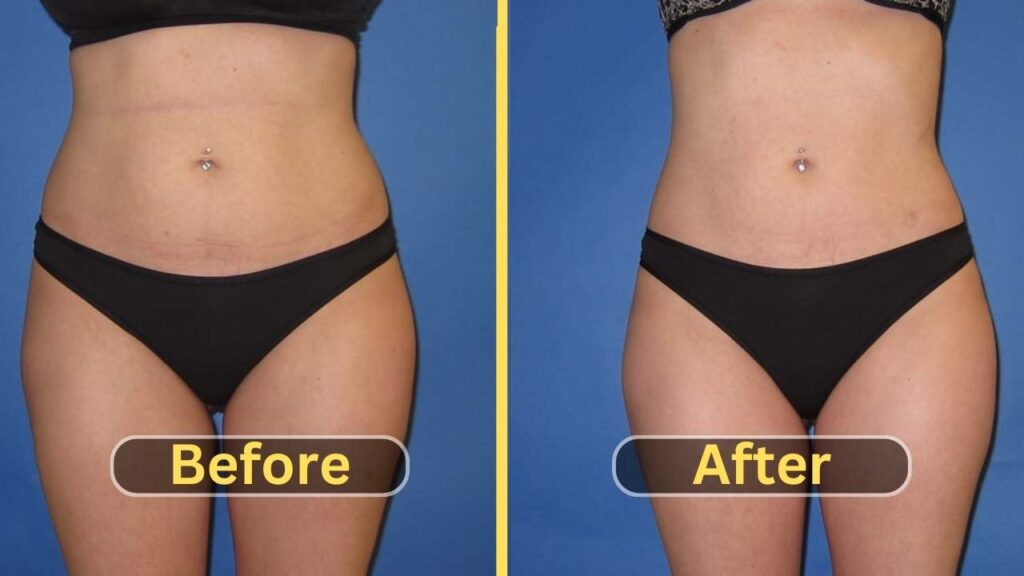 Lipo 360 Before and After flat belly