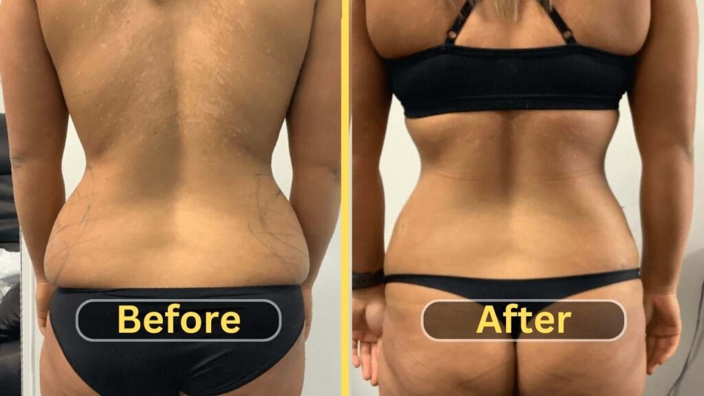 Lipo 360 Before and After love handles