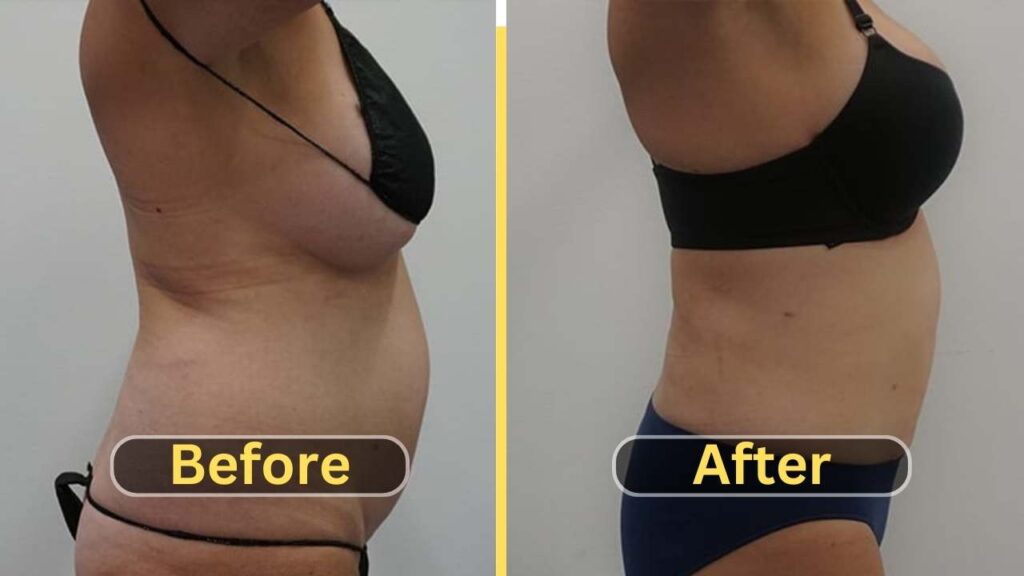 Lipo 360 Before and After side fat