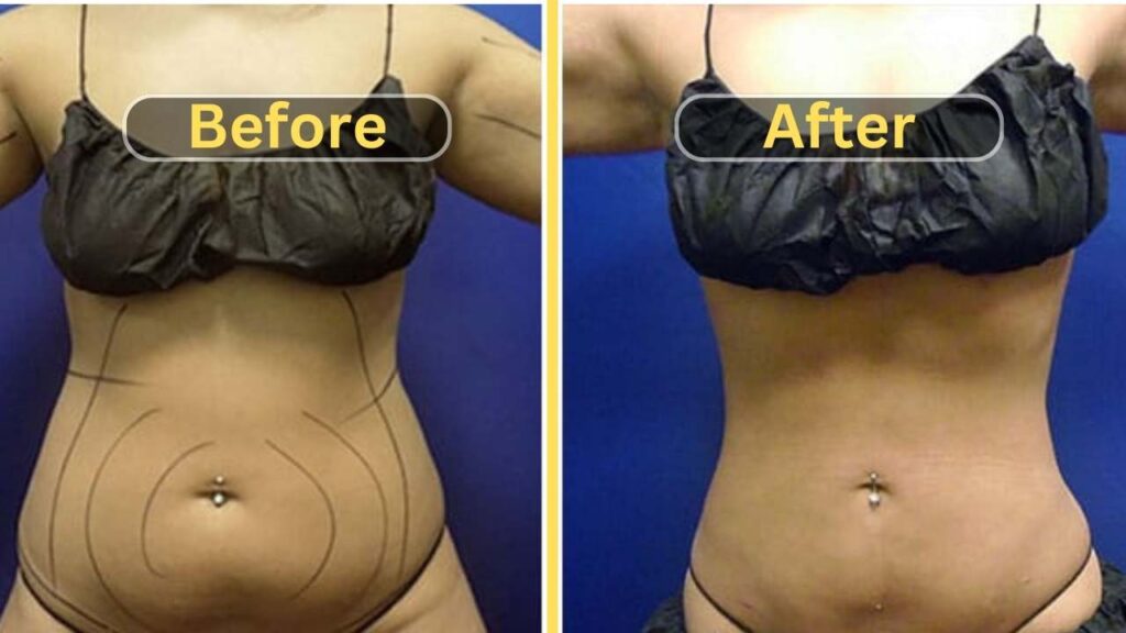 Lipo 360 Before And After Transformations Get A Dream Body With